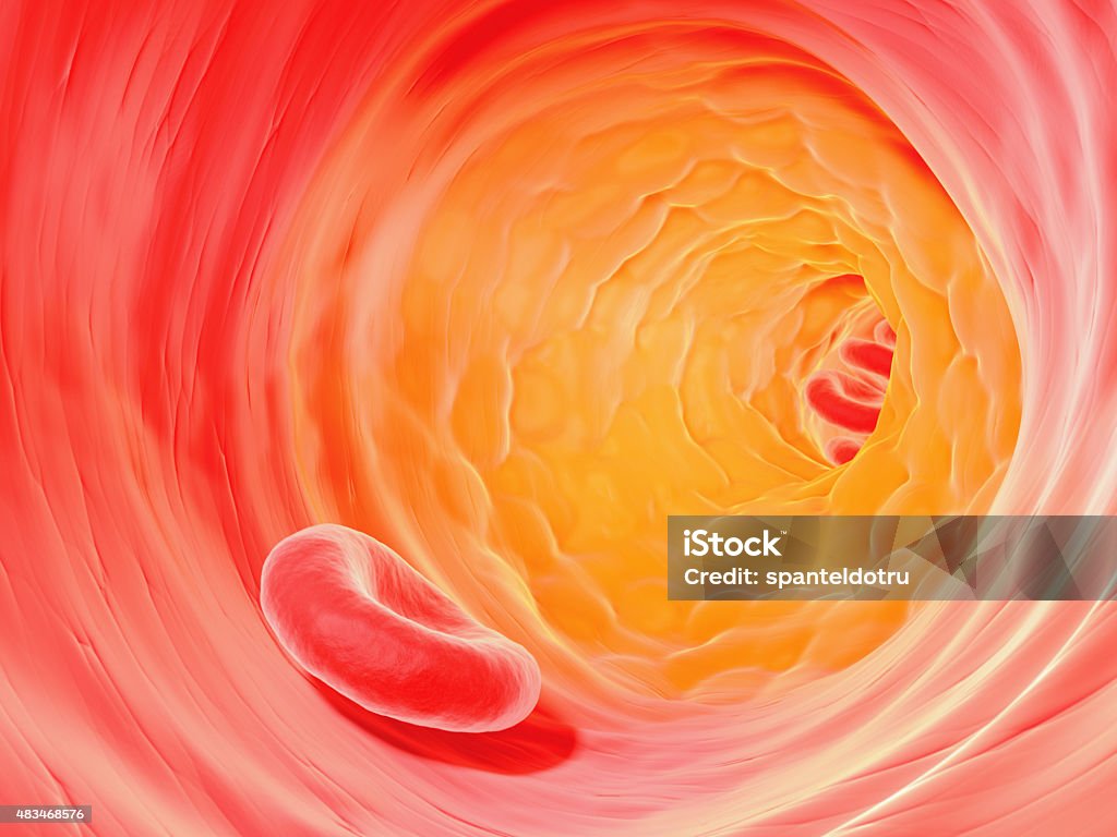 Cholesterol plaque in artery Atherosclerosis plaque prevents normal blood flow in affected artery. Medical background. Cholesterol Stock Photo