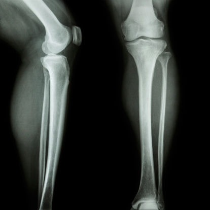 film x-ray knee & leg AP/lateral