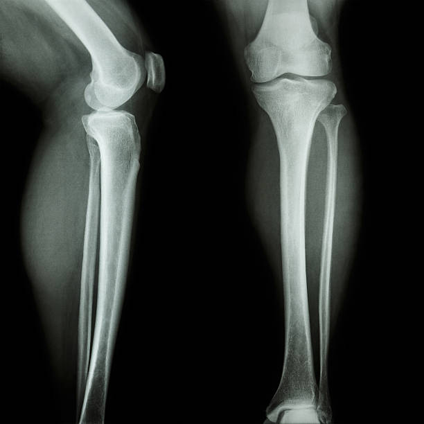 пленка рентген колена & ноги ap/боковой - tibia стоковые фото и изображения