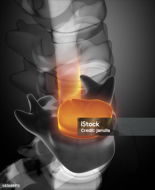 Scheibe Herniation In Xray Blick Stockfoto und mehr Bilder von Bandscheibe - Bandscheibe, Anatomie, Arthritis