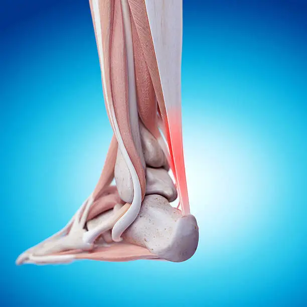 medically accurate illustration - painful achilles tendon