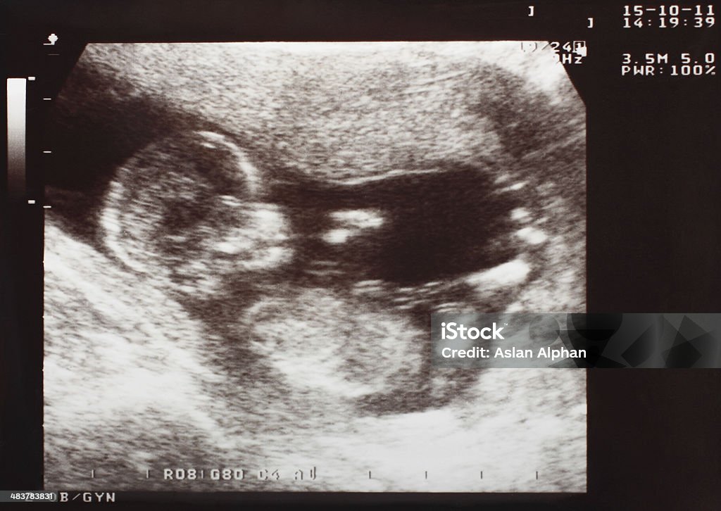 Baby Ultrasound Scan Ultrasound Stock Photo