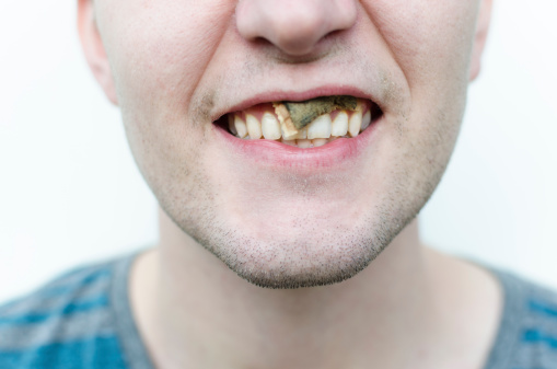 A man smiling, revealing a snus pouch under his lip. Snus is a tobacco product consumed orally; also commonly known as dip and chew among others. 