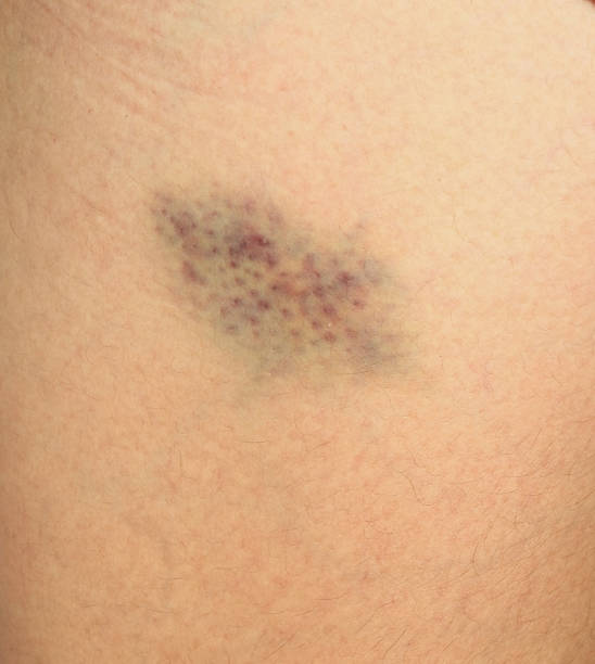 istock Closeup Bruise on wounded woman's leg skin 483862908