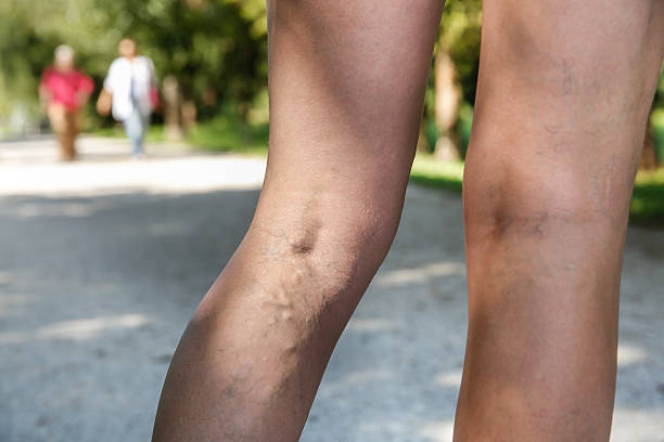 dolor en las venas varicosas y araña en womans legs - animal vein fotos fotografías e imágenes de stock