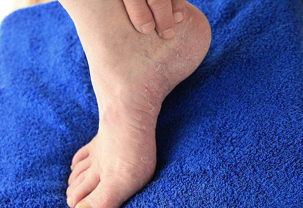 Plan rapproché de la peau sèche des pieds - Photo
