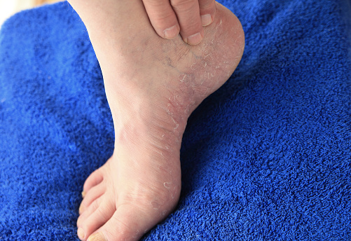 Senior man's foot with dry, peeling skin