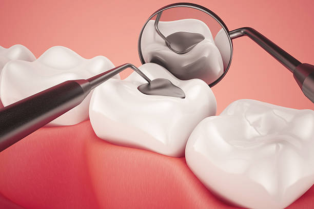 How Composite Fillings Restore Cavities Without Compromising Your Smile