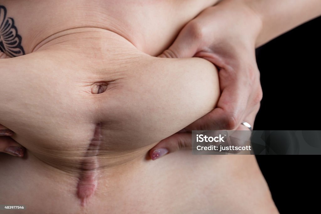 Stomach After a C-Section A woman with a tattoo grabbing the loose skin on her stomach after giving birth by c-section. Black Background Stock Photo