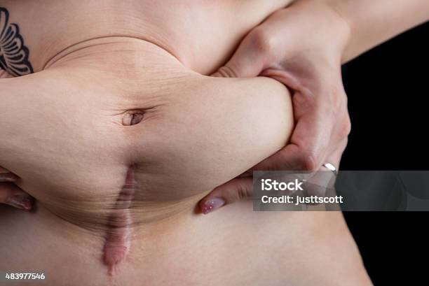 Stomach After A Csection Stock Photo - Download Image Now - Black Background, Childbirth, Scar