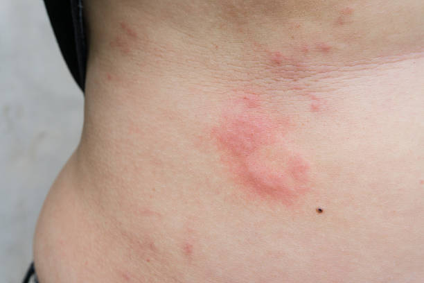 istock woman is urticaria on belly 484273184
