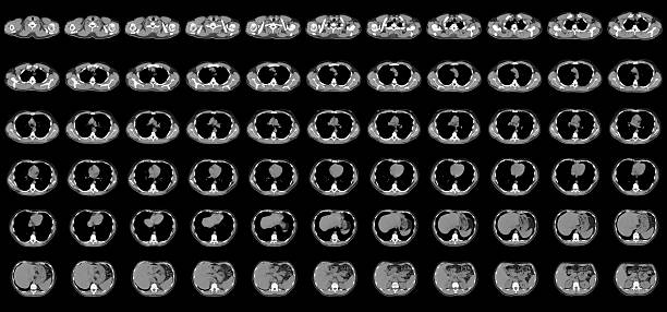 normale del torace sulla ct - roentgenogram foto e immagini stock