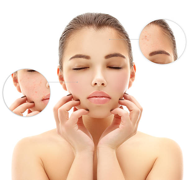 istock Portrait of girl with problem and clear skin 484345821