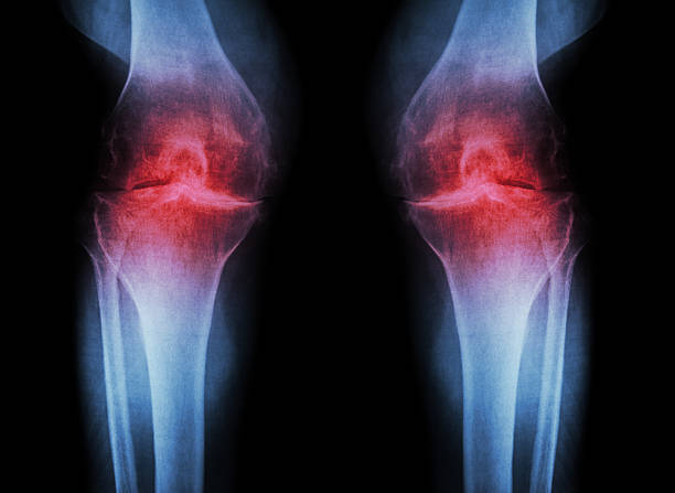 Osteoarthritis Knee ( OA Knee ) Osteoarthritis Knee ( OA Knee ) ( Film x-ray both knee with arthritis of knee joint : narrow knee joint space ) ( Medical and Science background ) tibia photos stock pictures, royalty-free photos & images