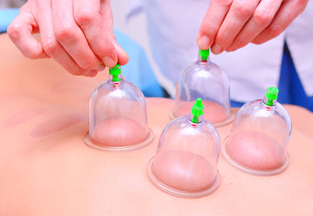 istock Cupping therapy, woman doctor removes cup from the patient's back 484372685