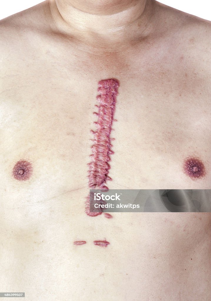 hypertrophic big scar big swell cicatrix - hypertrophic scar Scar Stock Photo