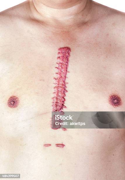 Hypertrophic Big Scar Stock Photo - Download Image Now - Scar, Surgery, Condition