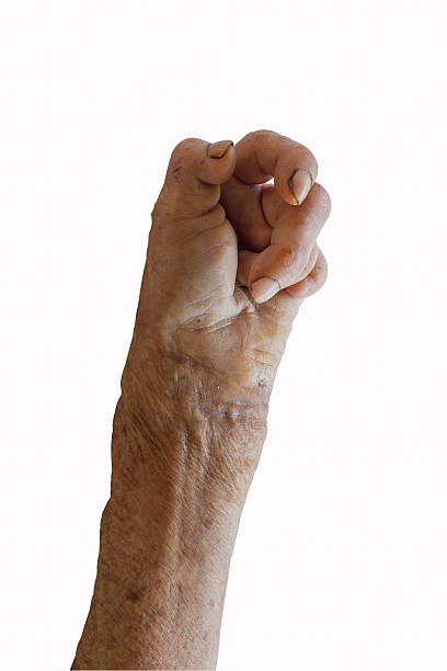 left hand of a leprosy left hand of a leprosy isolated on white background leprosy stock pictures, royalty-free photos & images