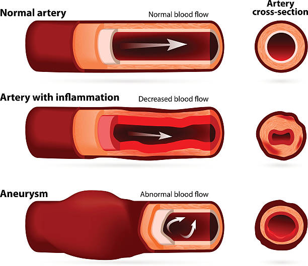 Normal artery, inflamed or narrowed artery and artery with an aneurysm Normal artery, inflamed or narrowed artery and artery with an aneurysm. cross-section clogged artery stock illustrations