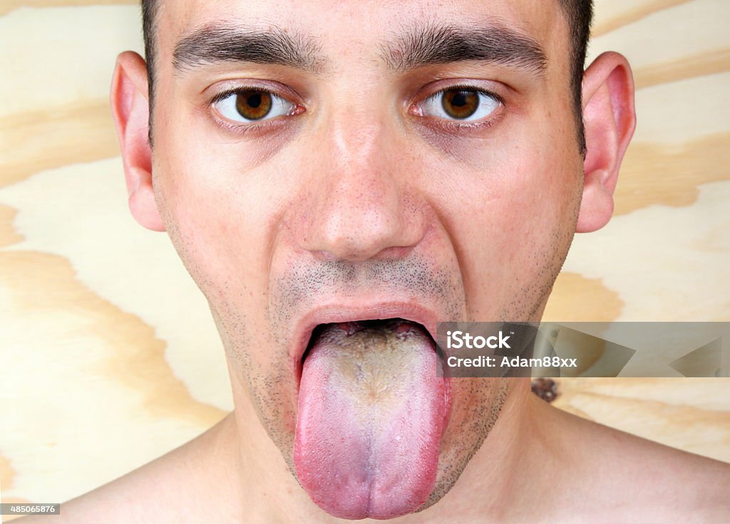 Infección de la lengua - Foto de stock de Treponema pálido libre de derechos