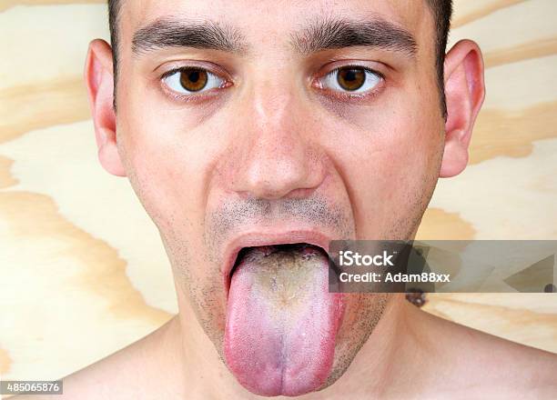 Infección De La Lengua Foto de stock y más banco de imágenes de Treponema pálido - Treponema pálido, 2015, Adulto