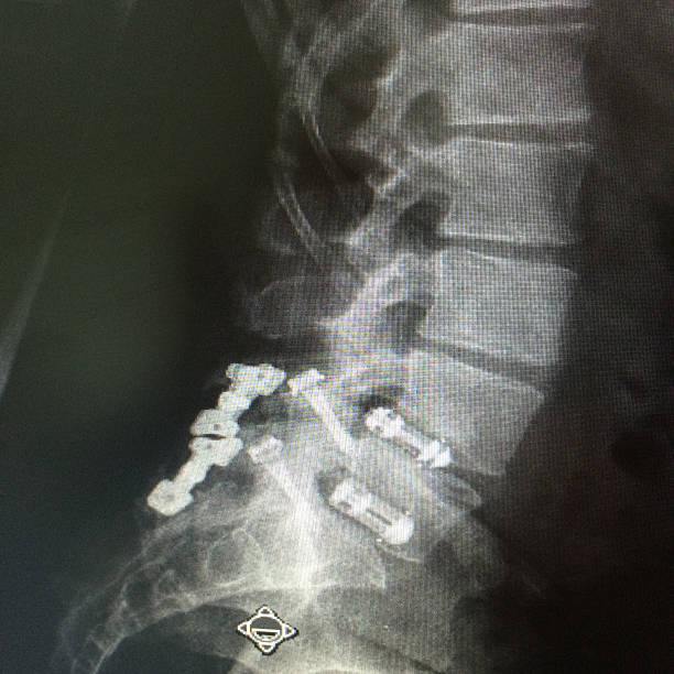 안되었음 요추 결합, intruments - orthopedic equipment osteoporosis x ray human spine 뉴스 사진 이미지