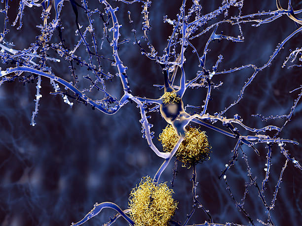 Alzheimer disease, neurons with amyloid plaques Amyloid plaques may damage and kill neurons by generating reactive oxygen species during its self-aggregation. atrophy photos stock pictures, royalty-free photos & images