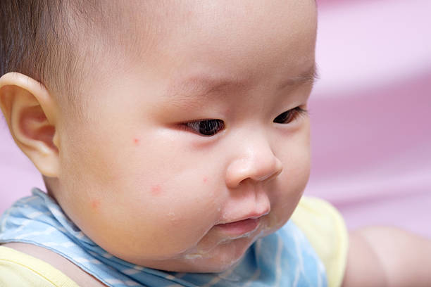 istock Mosquito bite Asian baby girl 485576138