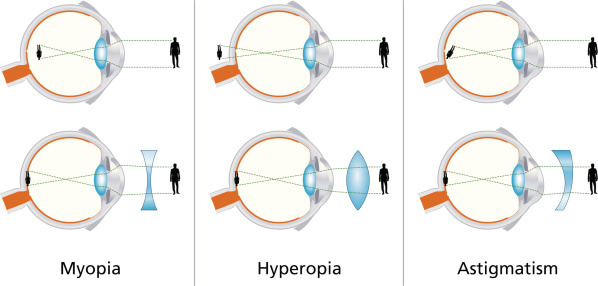 Illustration of the three visual defects Myopia, Hyperopia and Astigmatism and how to correct it with biconcave and biconvex lenses - with glasses or contact lenses.