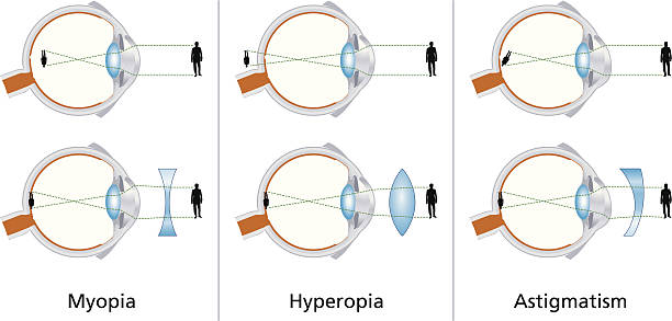 Visual Defects - Myopia, Hyperopia And Astigmatism Illustration of the three visual defects Myopia, Hyperopia and Astigmatism and how to correct it with biconcave and biconvex lenses - with glasses or contact lenses. myopia stock illustrations