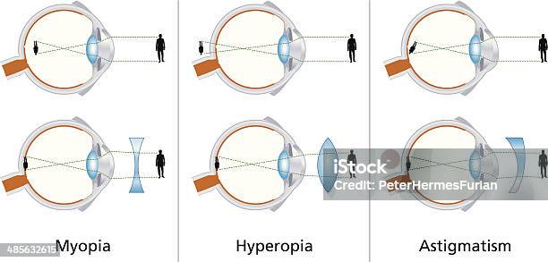Visual Defects Myopia Hyperopia And Astigmatism Stock Illustration - Download Image Now - Myopia, Astigmatism, Eye