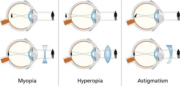 Vector illustration of Visual Defects - Myopia, Hyperopia And Astigmatism