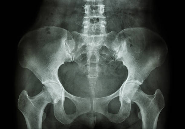 Film X-ray of Pelvis Film X-ray of Pelvis hip joint x stock pictures, royalty-free photos & images