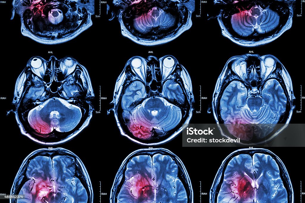 Film MRI (résonance magnétique de cerveau Images - Photo de Attaque cérébrale libre de droits