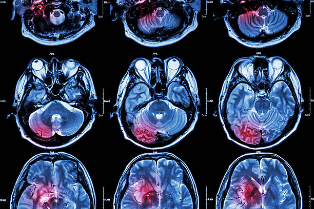 Film MRI ( Magnetic resonance imaging ) of brain Film MRI ( Magnetic resonance imaging ) of brain ( stroke , brain tumor , cerebral infarction , intracerebral hemorrhage )  ( Medical , Health care , Science Background ) ( Cross section of brain ) infarction photos stock pictures, royalty-free photos & images