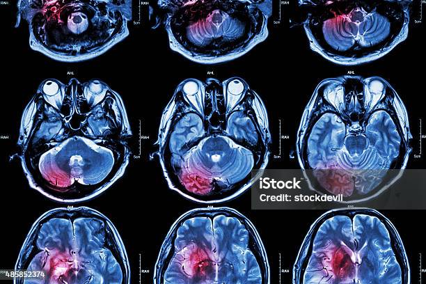Film Mri Of Brain Stock Photo - Download Image Now - MRI Scan, Stroke - Illness, Healthcare And Medicine