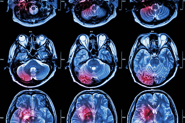 filme mri (ressonância magnética do cérebro de imagens - cat scan x ray medical scan x ray image - fotografias e filmes do acervo