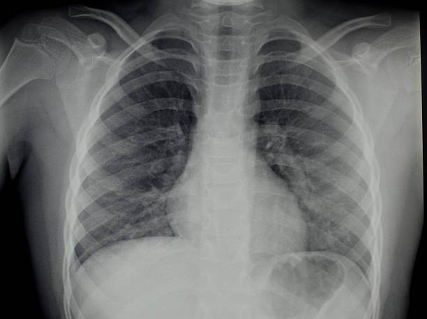 istock X-Ray of the Chest 486070337