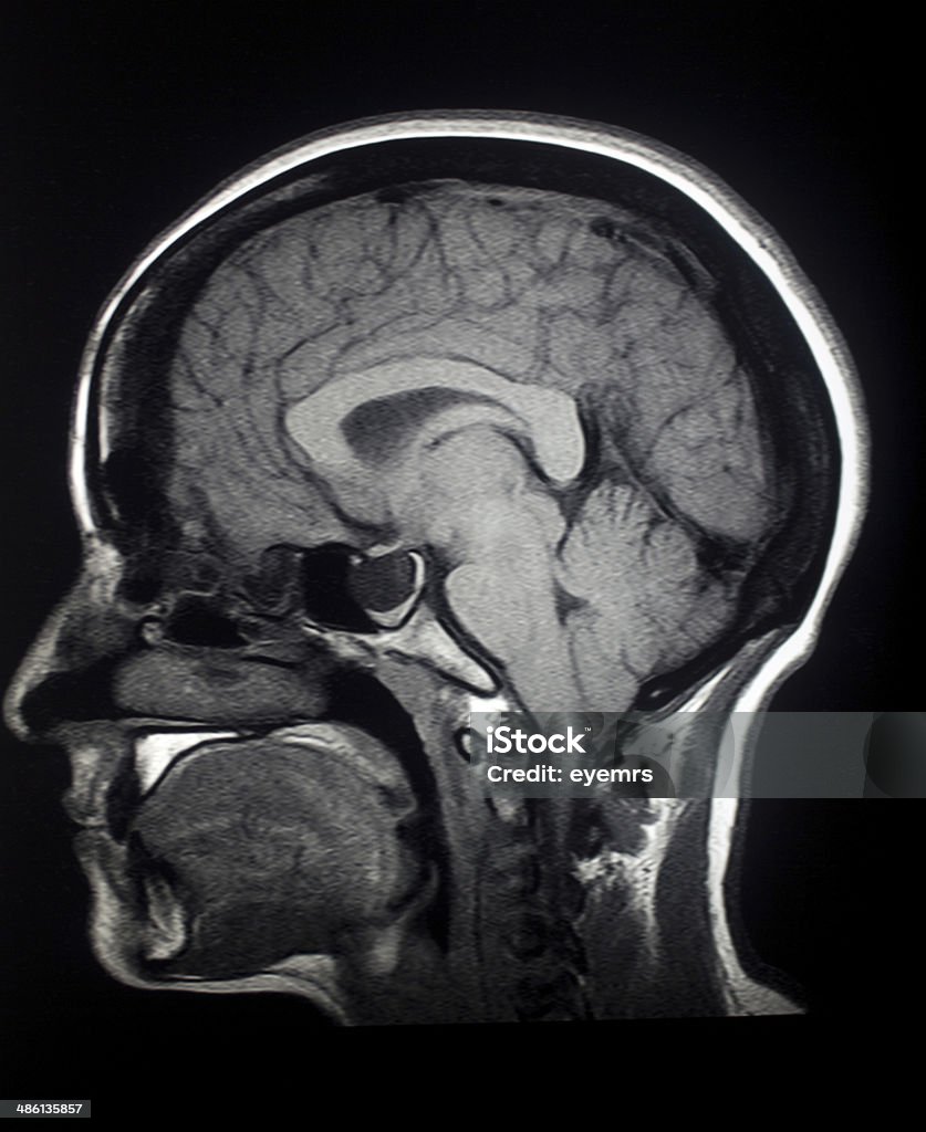 MRI Sagittal Brain Sagittal T1 MRI Brain MRI Scan Stock Photo
