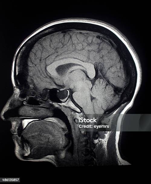 Mri Sagittal Brain Stock Photo - Download Image Now - MRI Scan, MRI Scanner, X-ray Image
