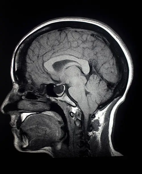 Photo of MRI Sagittal Brain