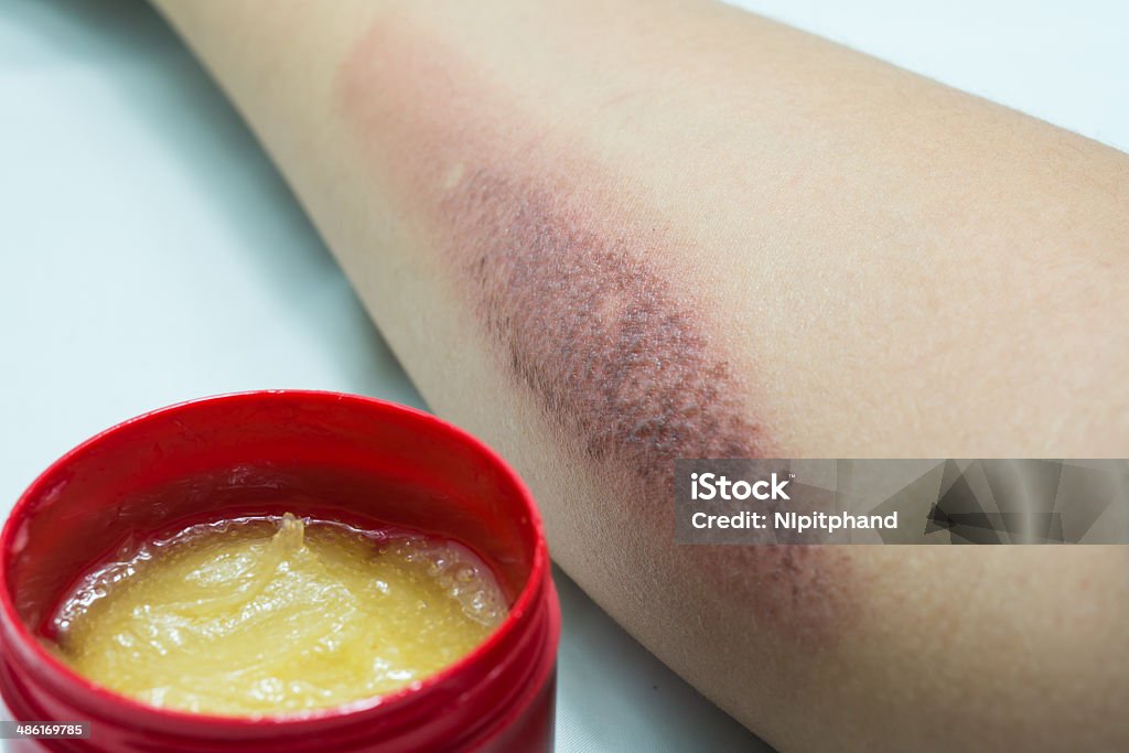 Arm with burn scar and medical ointment Arm with burn Scar and medical ointment Recovery Stock Photo
