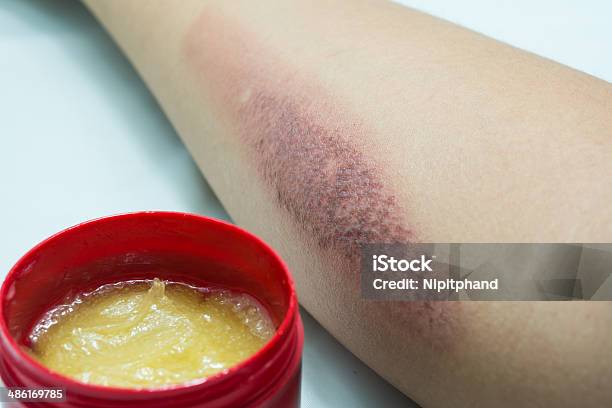 Arm With Burn Scar And Medical Ointment Stock Photo - Download Image Now - Recovery, Wound, Assistance