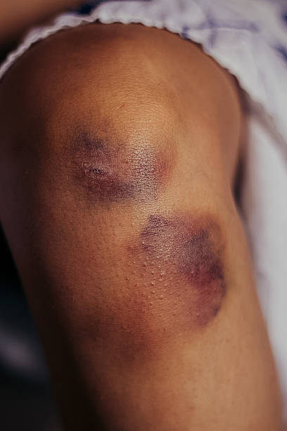 Woman nursing an injured bruised grazed knee with Woman nursing an injured bruised grazed knee with surface petechia on the skin and tissue discoloration in her hands in a healthcare and medical concept, close up of the joint and hands knee contusion bruised knee stock pictures, royalty-free photos & images
