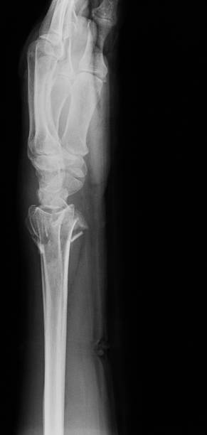 istock X-ray image of wrist joint, lateral view. 486188072