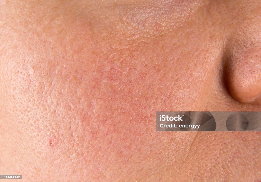 Acne scars Uneven Stock Photo