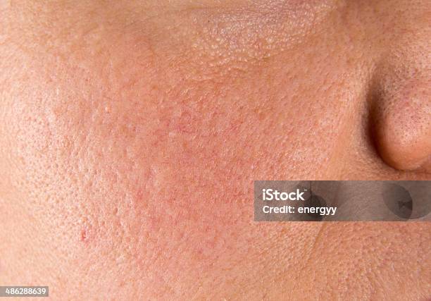 Acne Scars Stock Photo - Download Image Now - Uneven, Acne, Dermis