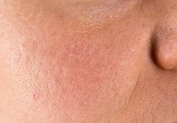 Photo of Acne scars