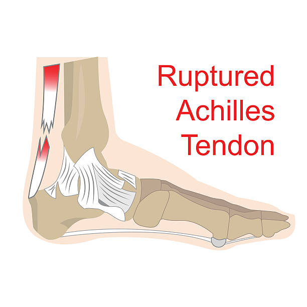 Tendonitis Graphics 320+ Tendinopathy Stock Illustrations, Royalty-Free Vector Graphics ...