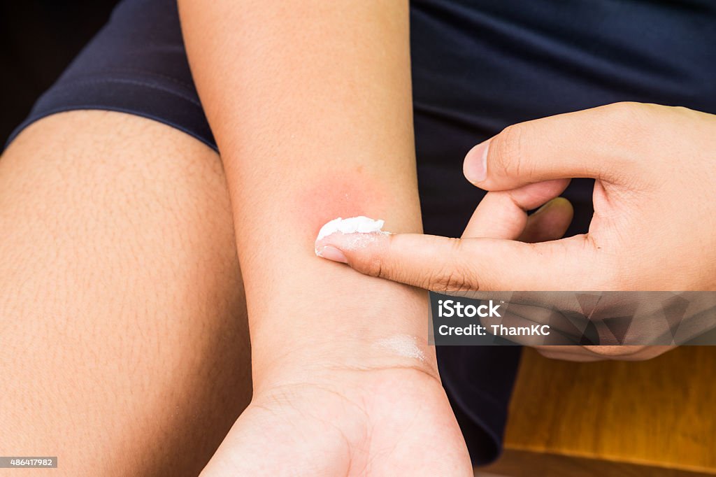 Baking soda being used to relieve itching from insect bites. Baking soda being used to relieve itching from insect bites Bug Bite Stock Photo